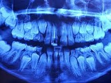 Dental X-Ray